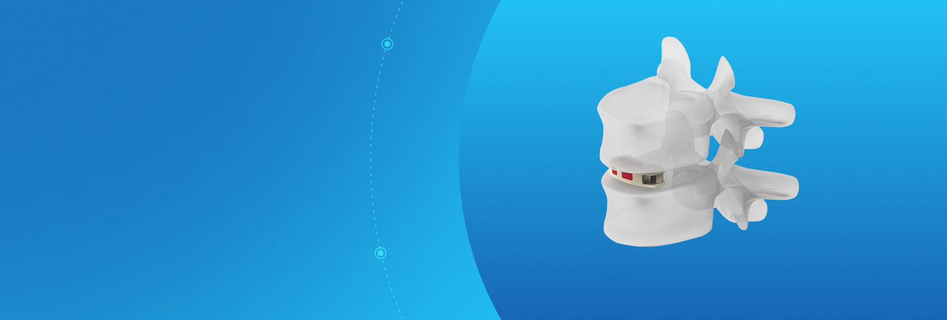 ALC Anterior Lumbar Cage Tlif Fusion alc-anterior-lumbar-cage-tlif-fusion