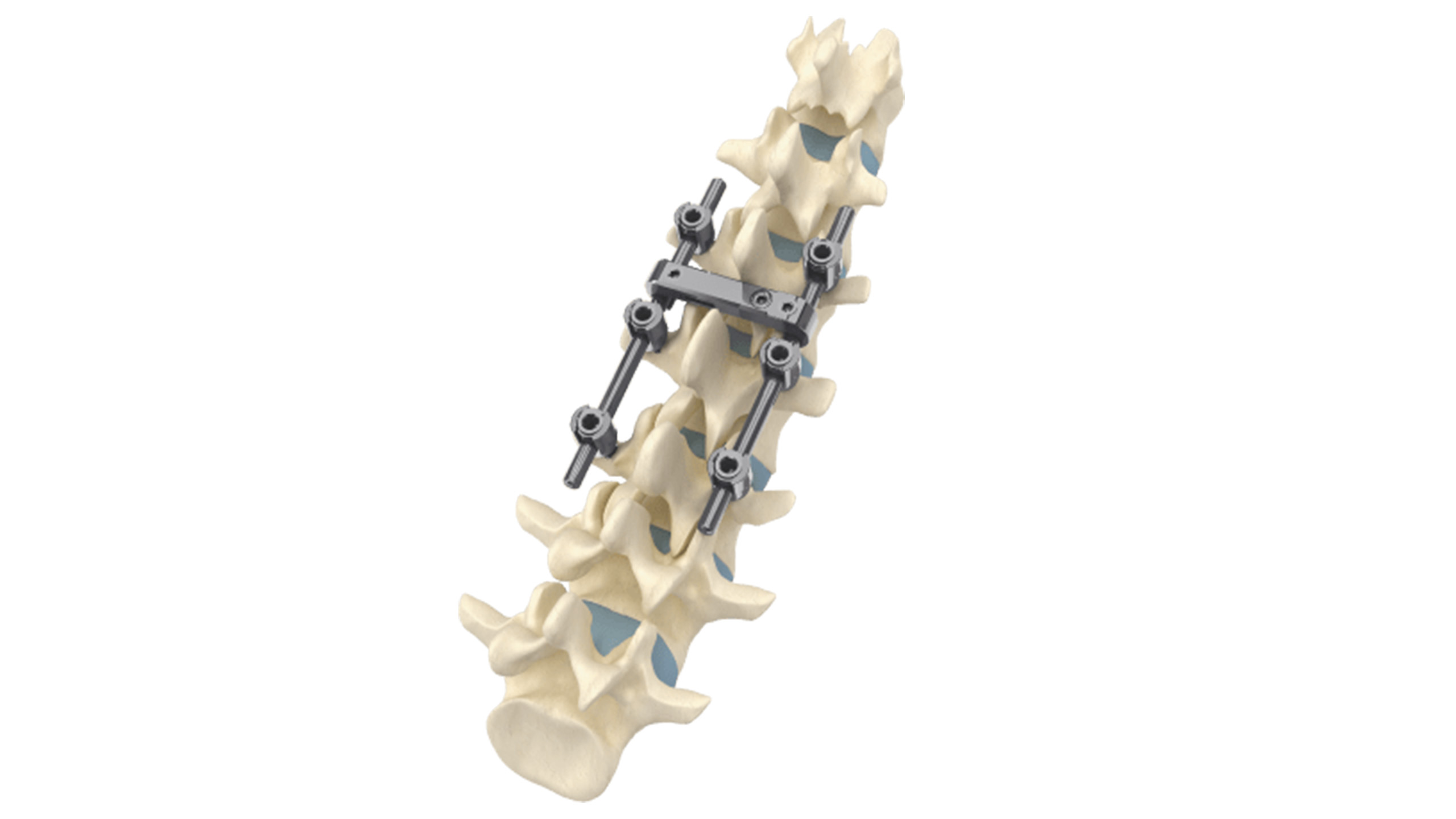 Pedicle Screw Spinal Fixation System