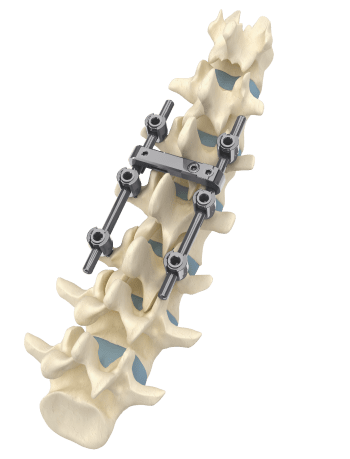 MS - I Spinal Fixation System