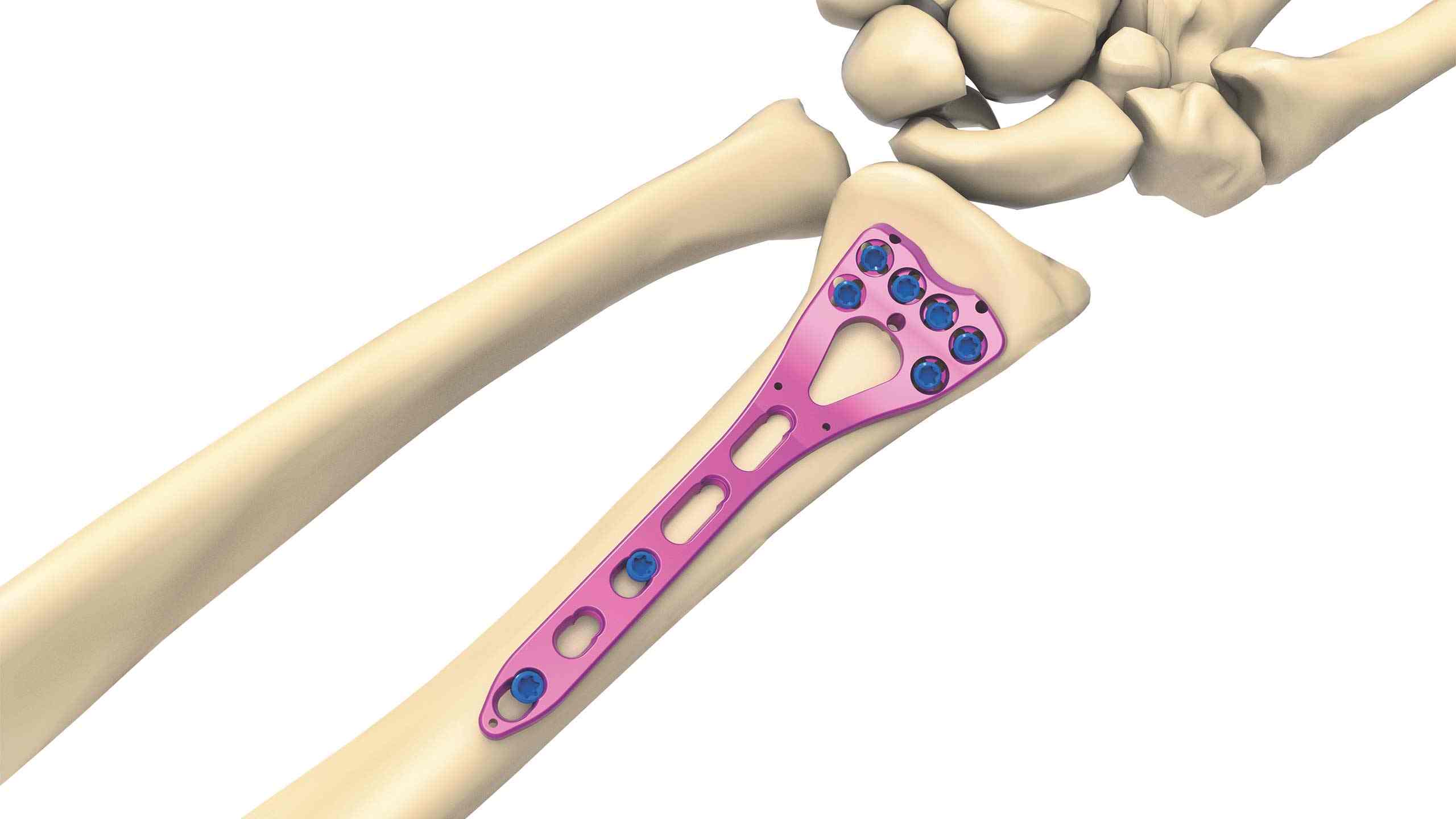 Volar Distal Radius Plate Two Column Variable Angle 