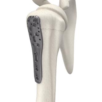 Philos Plate - Upper Limb System (ASLP)