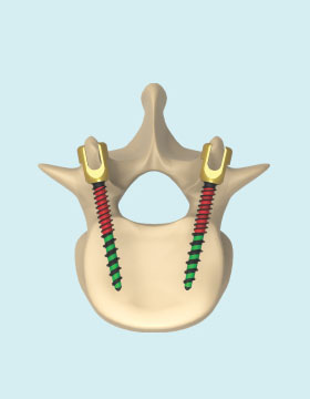 MS II Spinal Fixation System