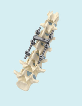 MS I Spinal Fixation System