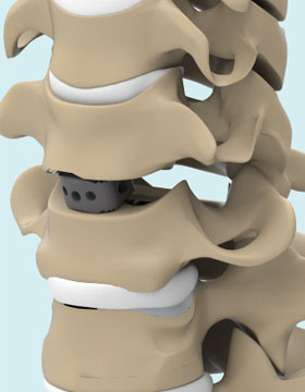 ACC Cervical Cage System