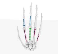 Hand and Wrist Trauma Implants