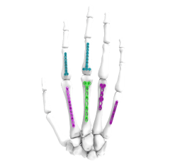 Hand and Wrist Trauma Implants