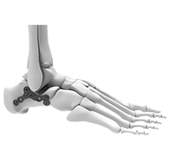 Foot and Ankle Trauma Implants